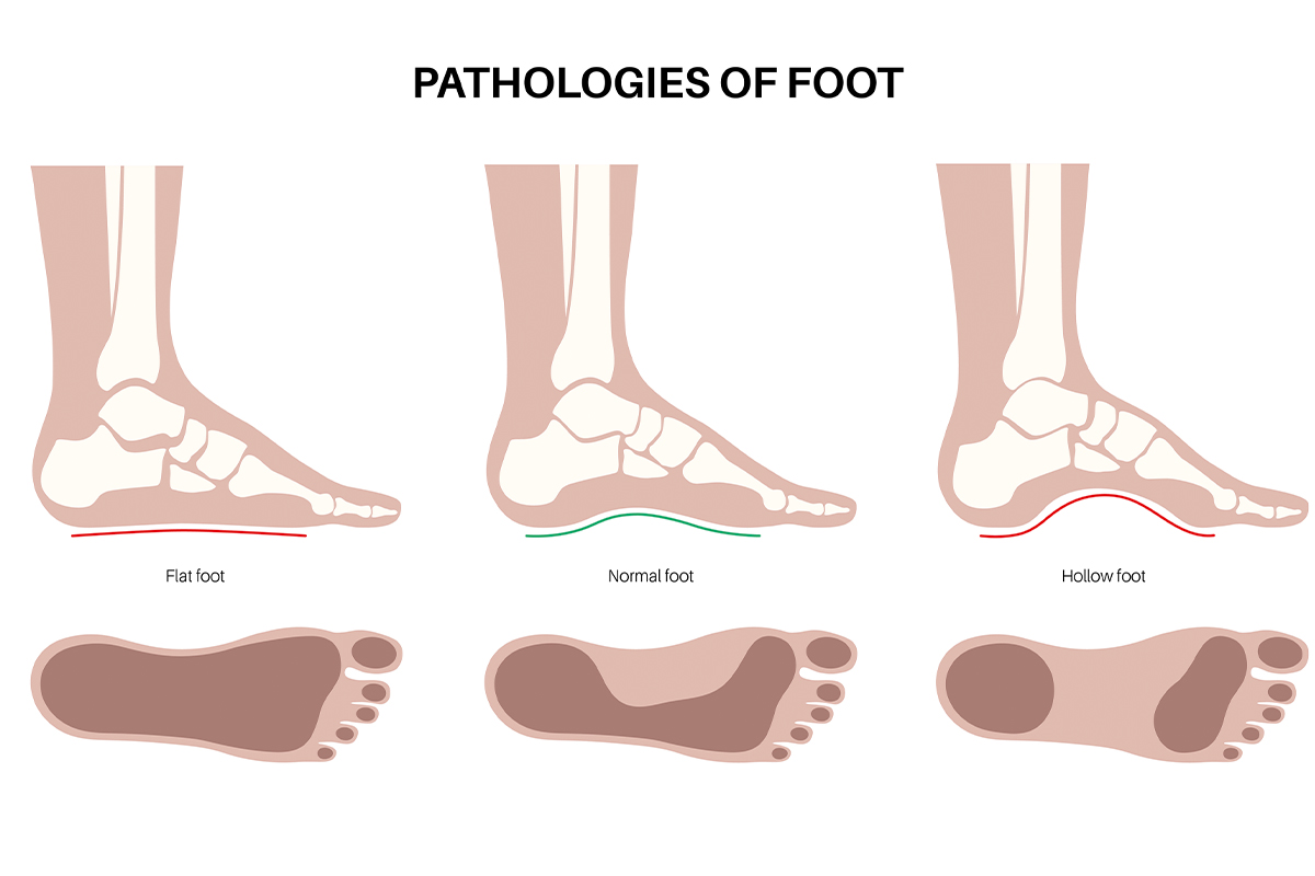 An illustration showing a foot with a high arch, requiring cavus foot treatment in San Francisco.