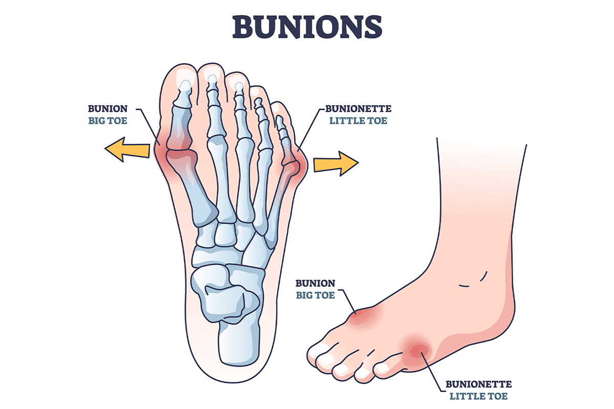 An illustration that shows bunions requiring bunion repair in San Francisco.