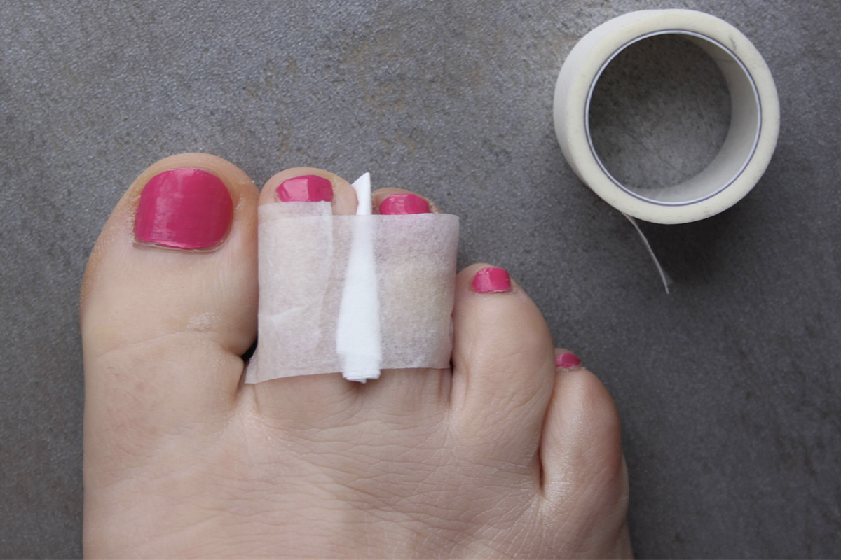 A woman's foot requiring broken foot treatment in San Francisco.