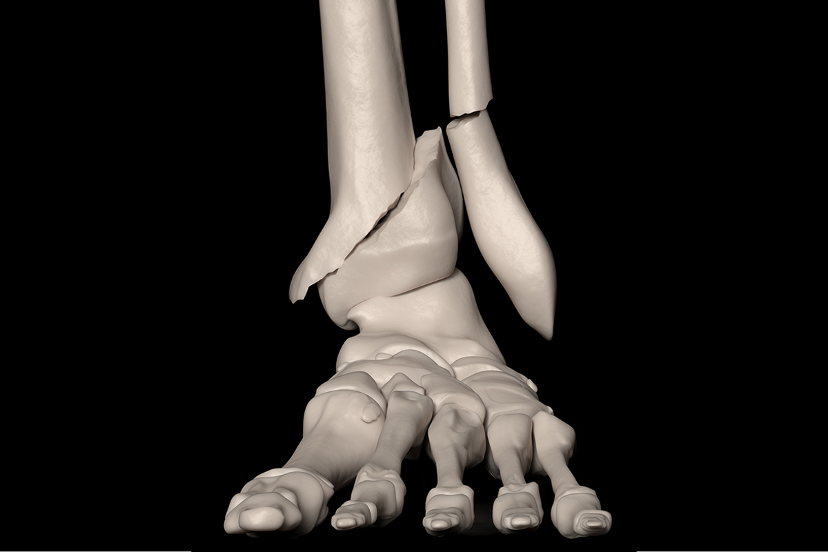 A 3D rendering of the bones of the feet which need broken foot treatment in San Francisco.
